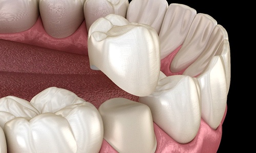 A digital image of the bottom arch of teeth with a dental crown being placed over a weakened tooth