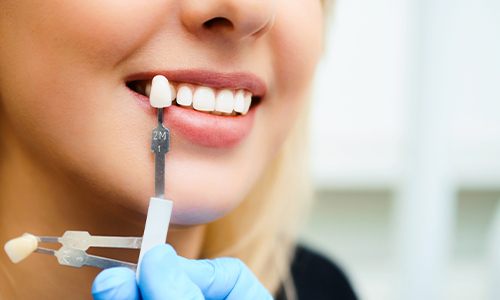Closeup of smile during cosmetic dentistry consultation
