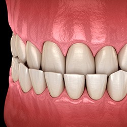 Illustration of an underbite