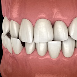 Illustration of a crossbite