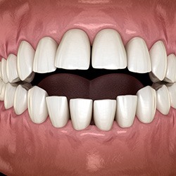 Illustration of an open bite